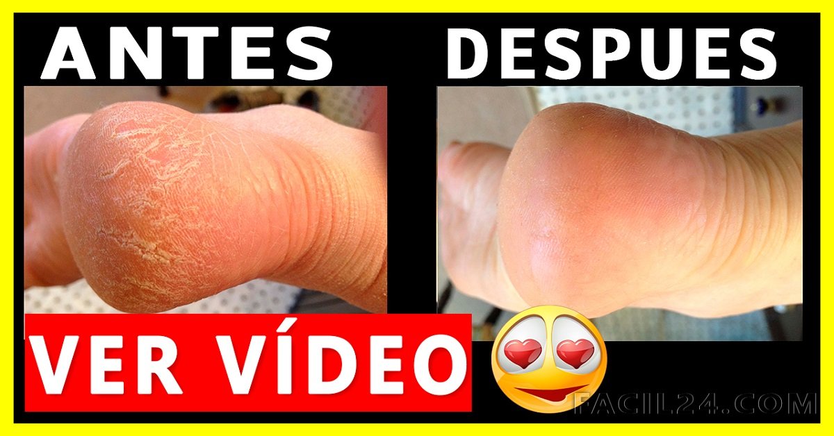 Aprende a Como EXFOLIAR los PIES con esto y dígale adiós a las varices, los callos y talones agrietados rapidamente.